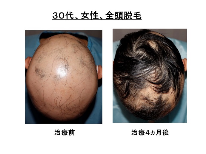 円形脱毛症　病院